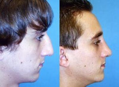 Male Rhinoplasty Before & After Gallery - Patient 122406409 - Image 1