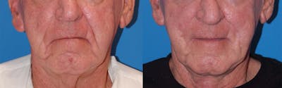 Nasolabial Folds Before & After Gallery - Patient 122406410 - Image 1
