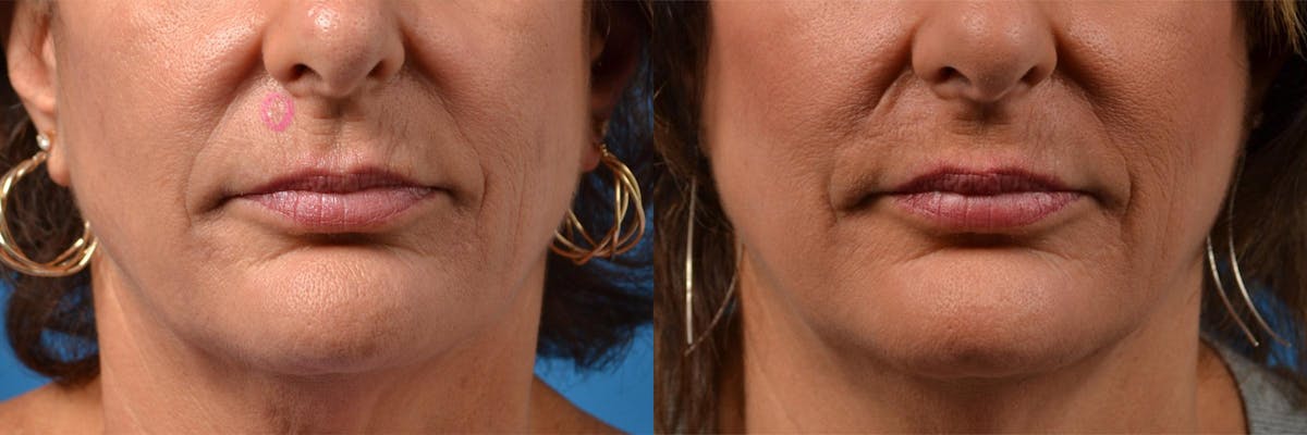Mohs Surgery and Skin Cancer Before & After Gallery - Patient 122406411 - Image 6