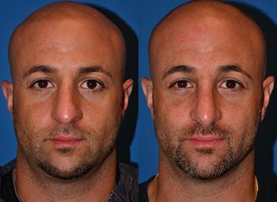 Rhinoplasty Before & After Gallery - Patient 142763000 - Image 1