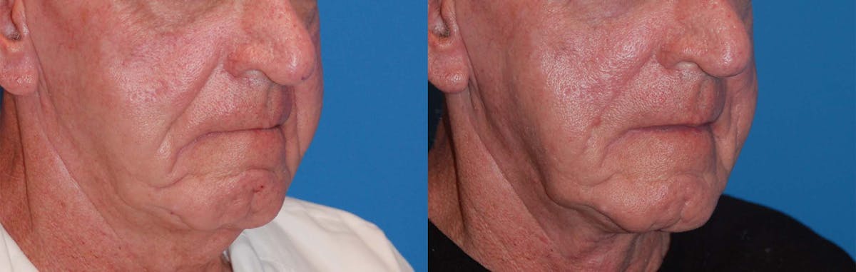 Nasolabial Folds Before & After Gallery - Patient 122406410 - Image 2