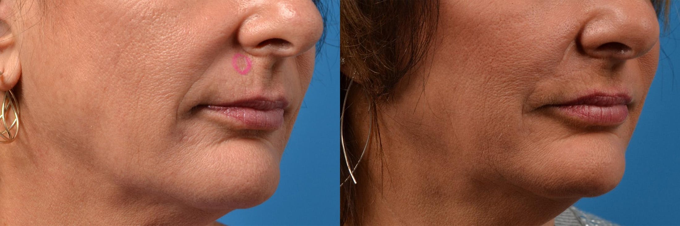 Mohs Surgery and Skin Cancer Before & After Gallery - Patient 122406411 - Image 7