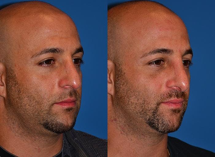 Rhinoplasty Before & After Gallery - Patient 142763000 - Image 2