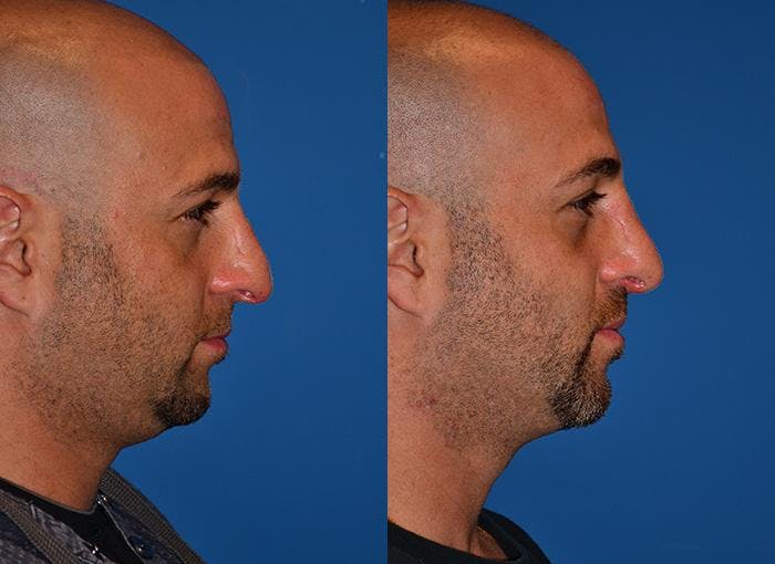 Rhinoplasty Before & After Gallery - Patient 142763000 - Image 3