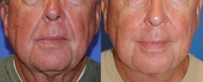Nasolabial Folds Before & After Gallery - Patient 122406412 - Image 1