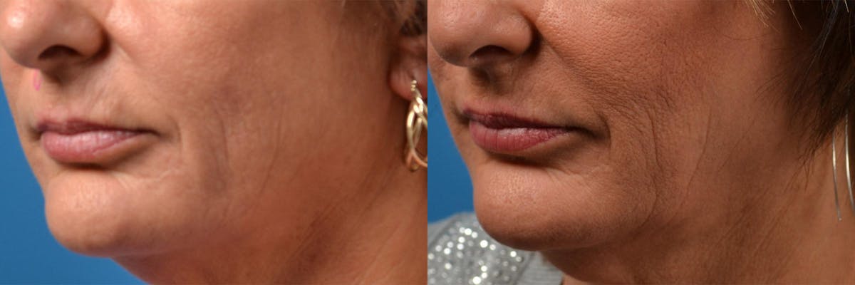 Mohs Surgery and Skin Cancer Before & After Gallery - Patient 122406411 - Image 8