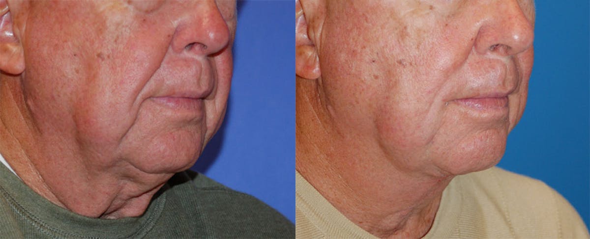 Nasolabial Folds Before & After Gallery - Patient 122406412 - Image 2