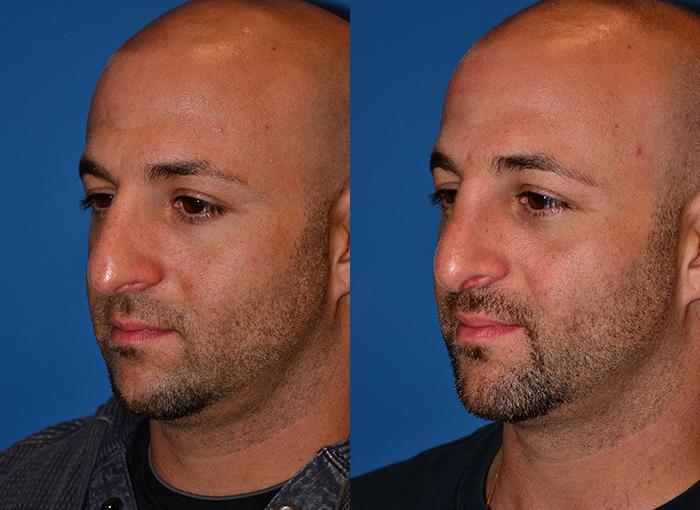Male Rhinoplasty Before & After Gallery - Patient 122406413 - Image 4