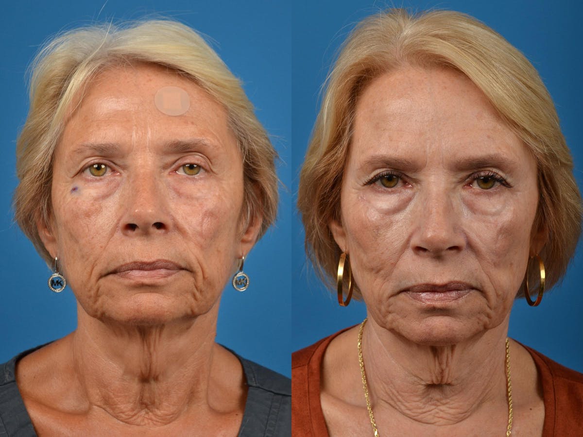 Mohs Surgery and Skin Cancer Before & After Gallery - Patient 122406417 - Image 1