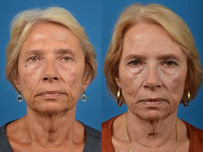 Mohs Surgery and Skin Cancer Before & After Gallery - Patient 122406417 - Image 1