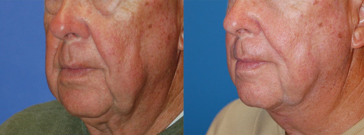Nasolabial Folds Before & After Gallery - Patient 122406412 - Image 3
