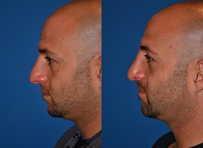 Rhinoplasty Before & After Gallery - Patient 142763000 - Image 5