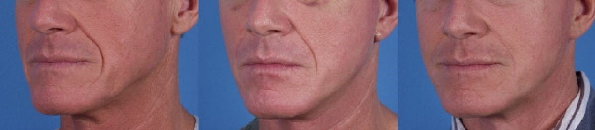 Nasolabial Folds Before & After Gallery - Patient 122406414 - Image 1