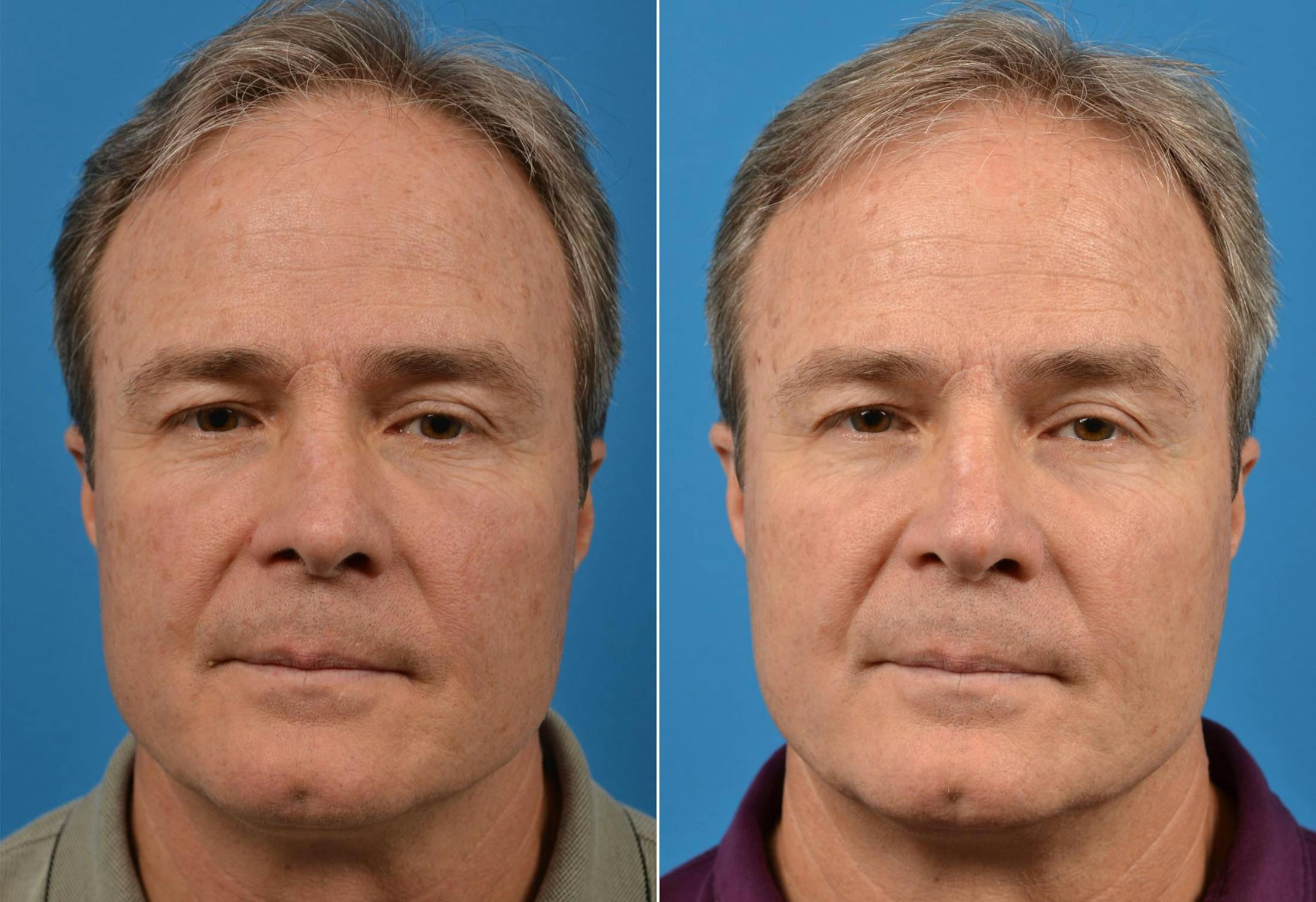 Male Rhinoplasty Before & After Gallery - Patient 122406419 - Image 1