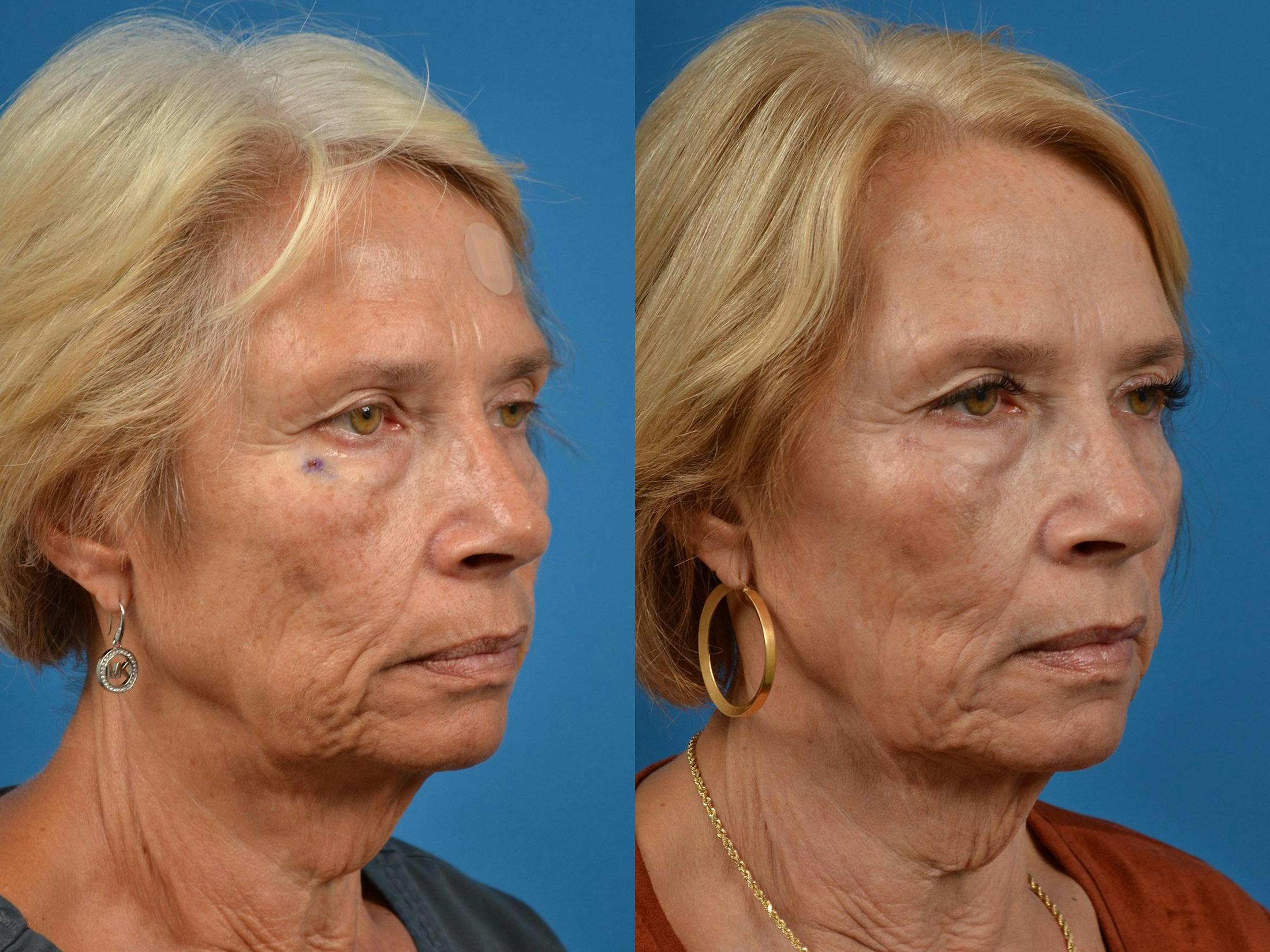 Mohs Surgery and Skin Cancer Before & After Gallery - Patient 122406417 - Image 2
