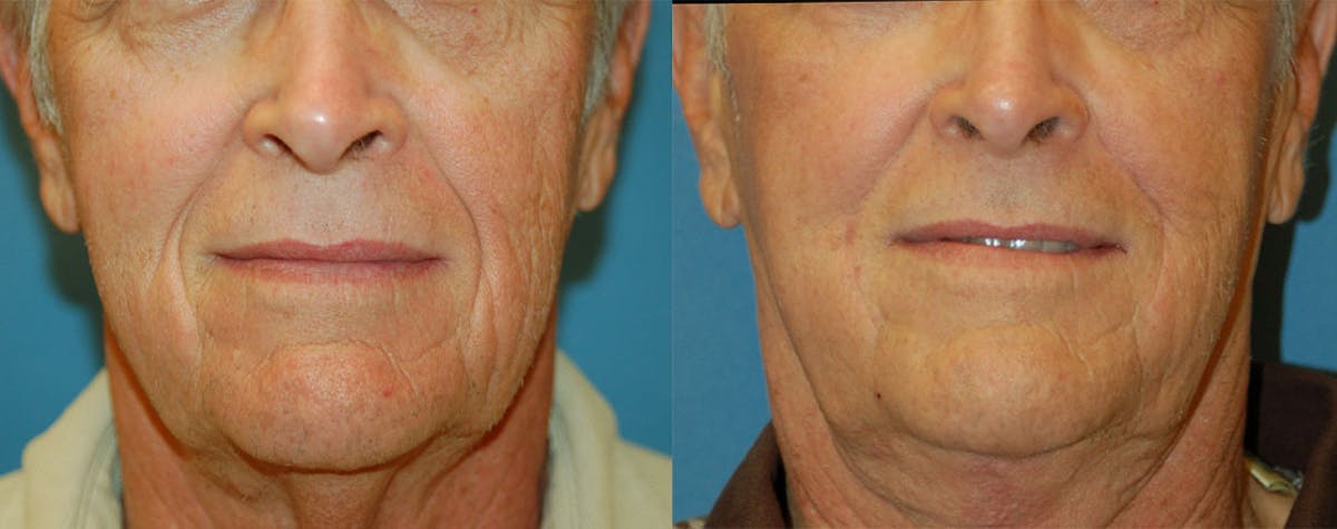 Nasolabial Folds Before & After Gallery - Patient 122406416 - Image 1