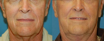 Nasolabial Folds Before & After Gallery - Patient 122406416 - Image 1