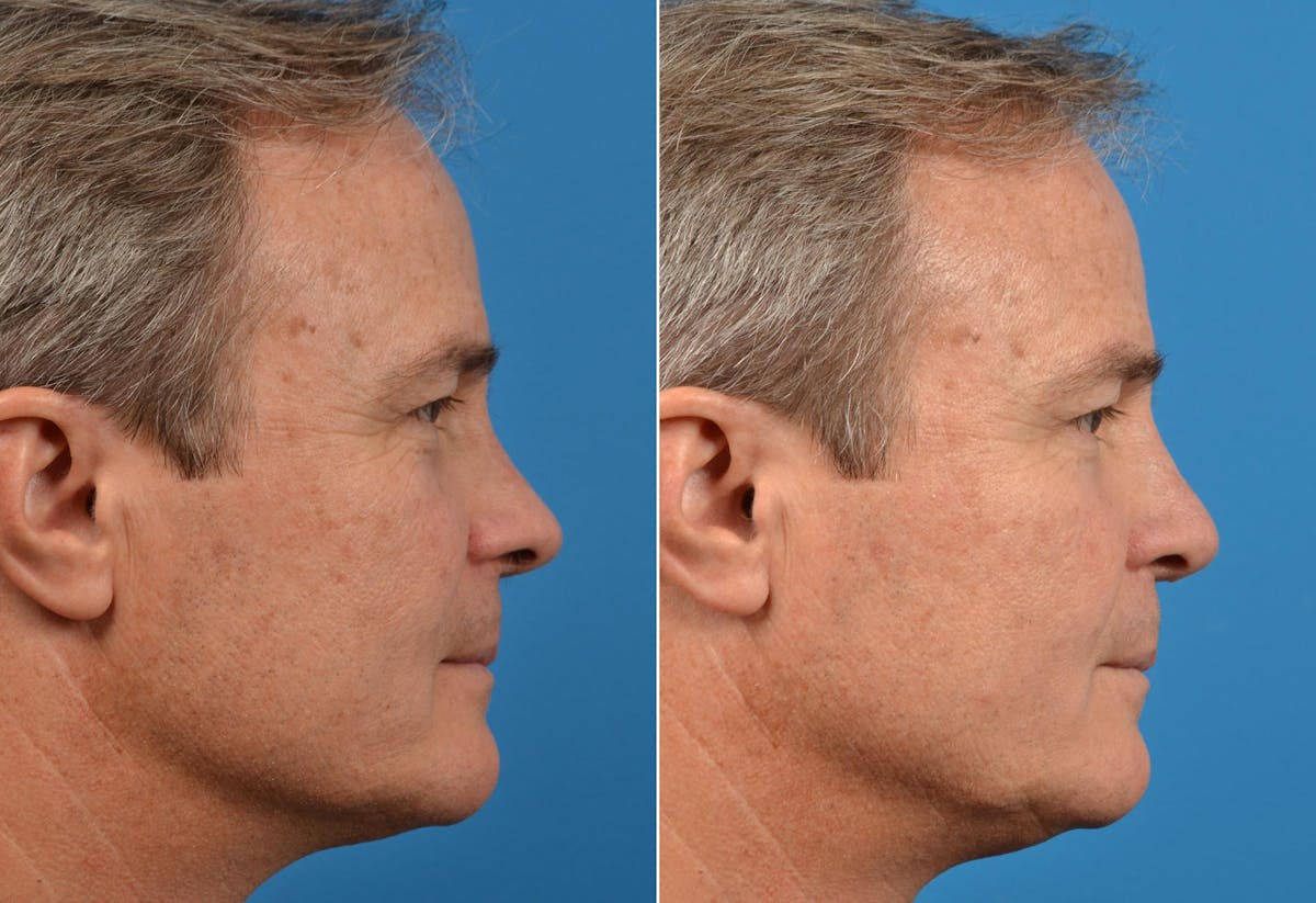Male Rhinoplasty Before & After Gallery - Patient 122406419 - Image 2