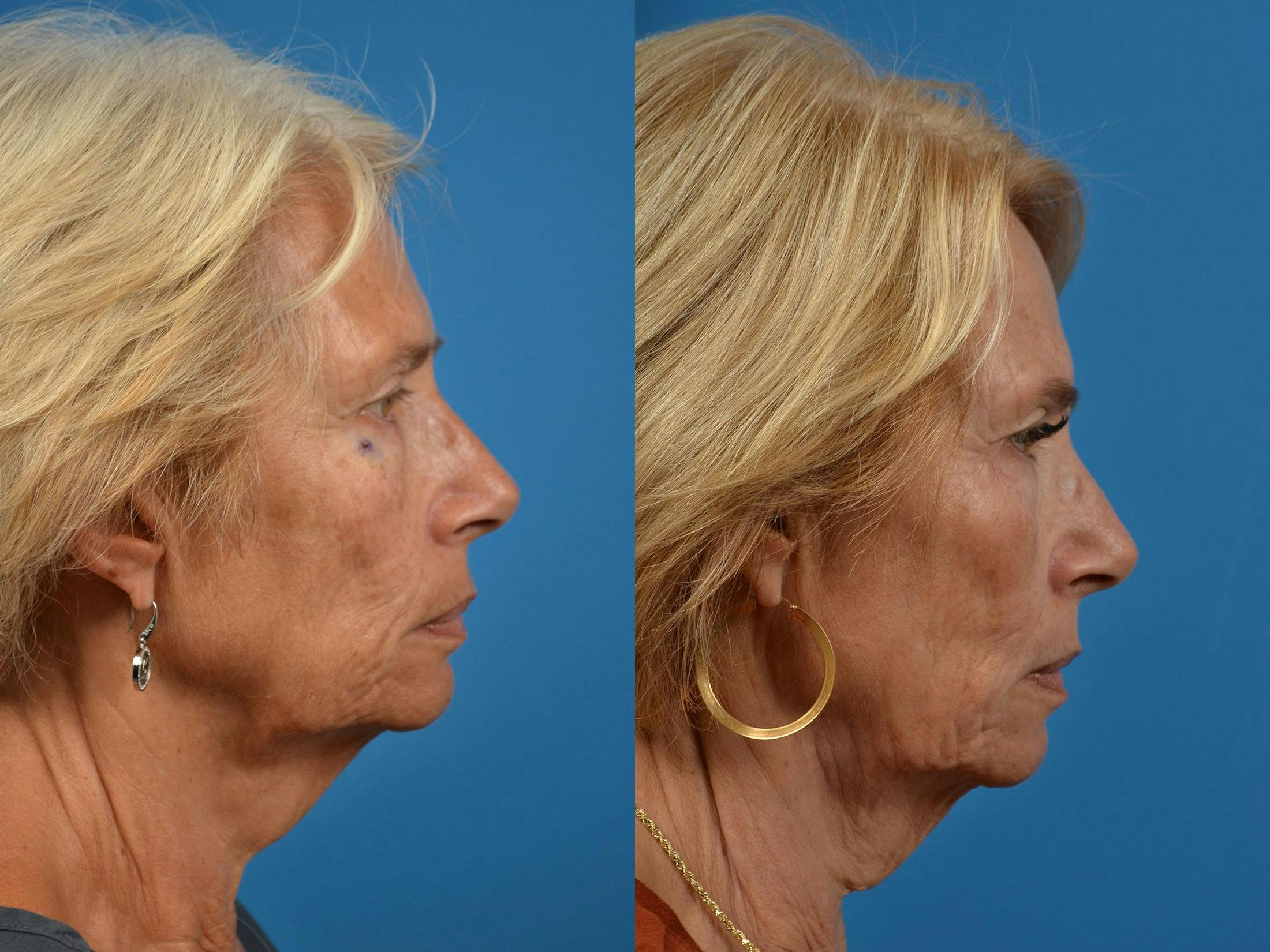Mohs Surgery and Skin Cancer Before & After Gallery - Patient 122406417 - Image 3