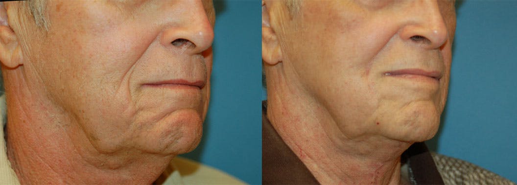 Nasolabial Folds Before & After Gallery - Patient 122406416 - Image 2