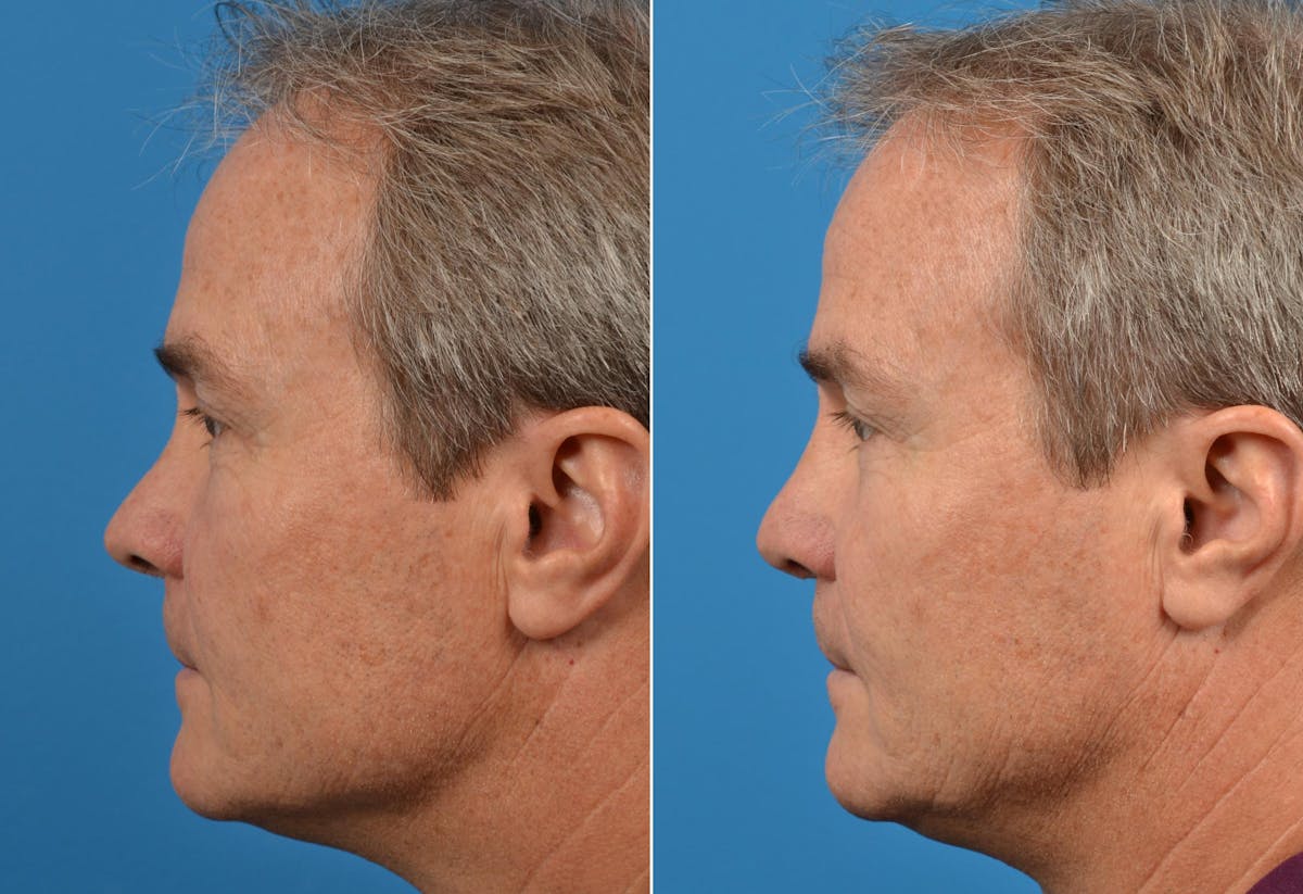 Rhinoplasty Before & After Gallery - Patient 142763002 - Image 3