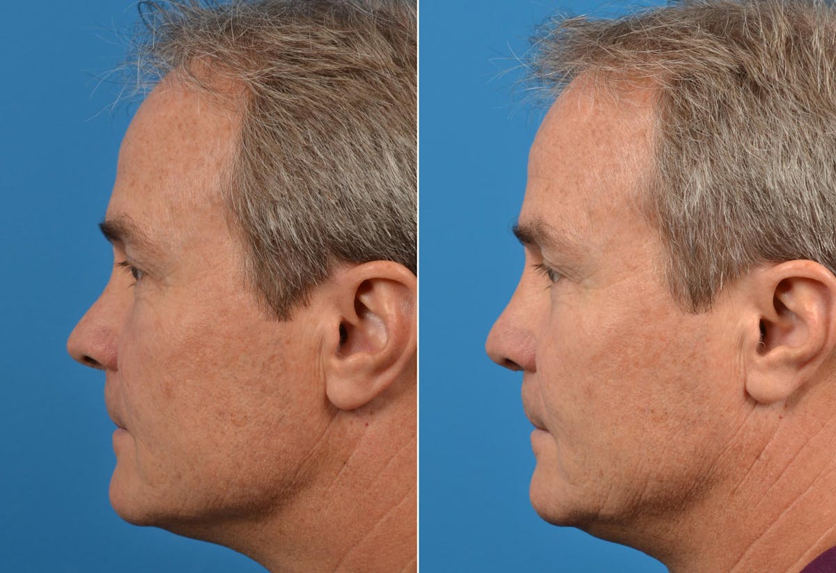 Male Rhinoplasty Before & After Gallery - Patient 122406419 - Image 3