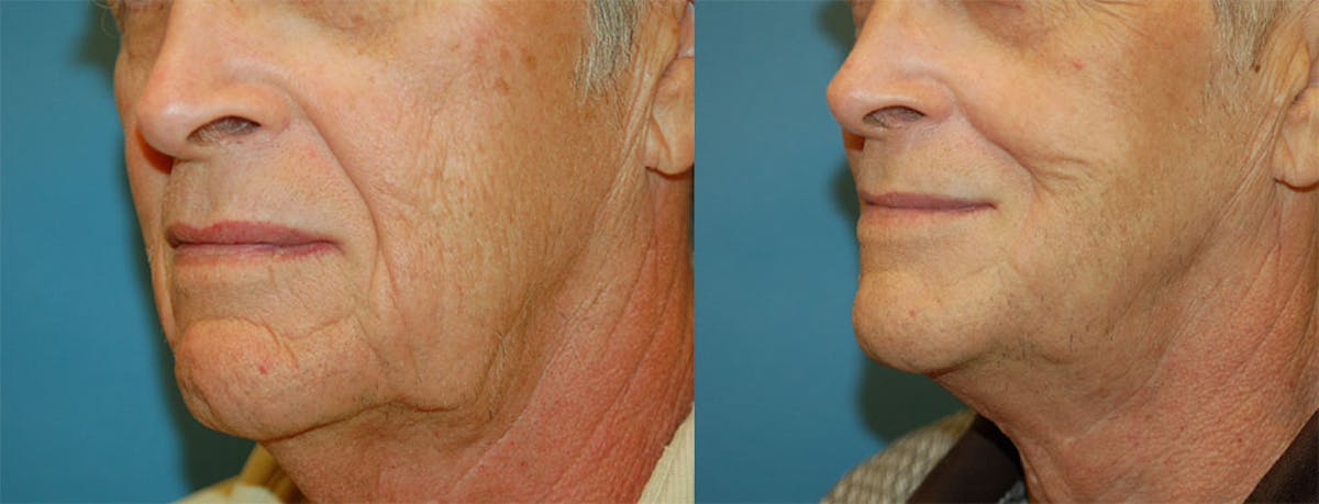 Nasolabial Folds Before & After Gallery - Patient 122406416 - Image 3