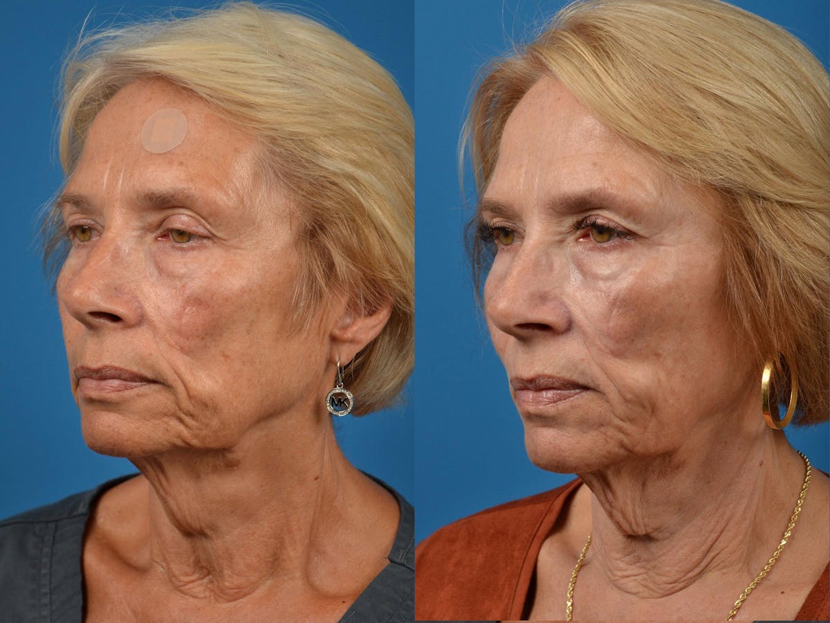Mohs Surgery and Skin Cancer Before & After Gallery - Patient 122406417 - Image 4