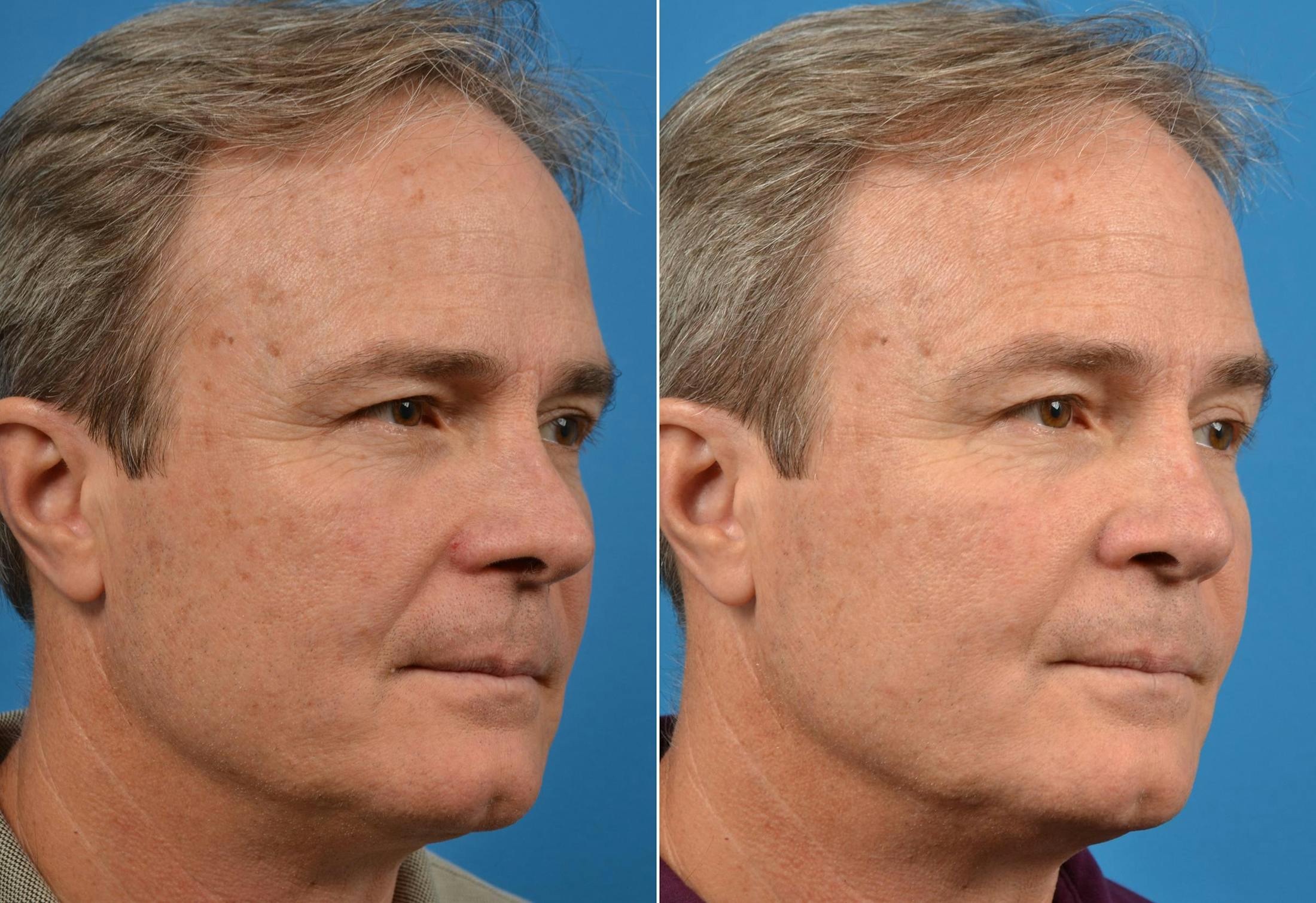 Rhinoplasty Before & After Gallery - Patient 142763002 - Image 4