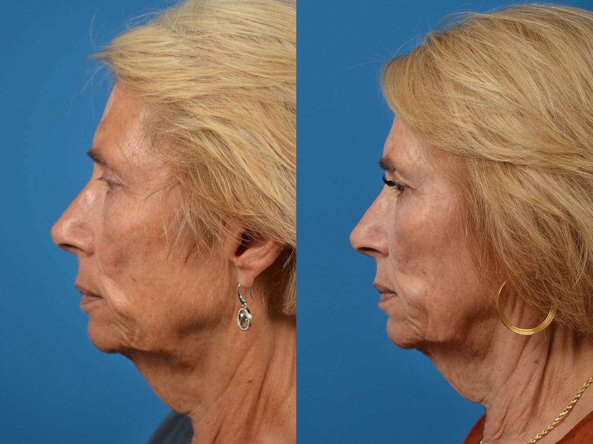 Mohs Surgery and Skin Cancer Before & After Gallery - Patient 122406417 - Image 5
