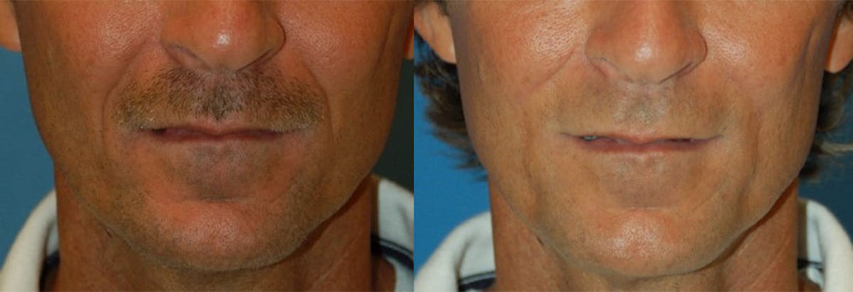 Nasolabial Folds Before & After Gallery - Patient 122406418 - Image 1