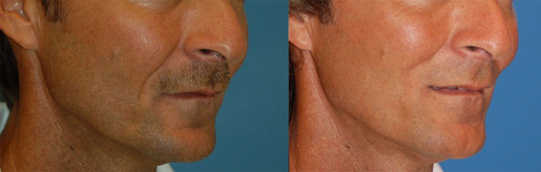 Nasolabial Folds Before & After Gallery - Patient 122406418 - Image 2