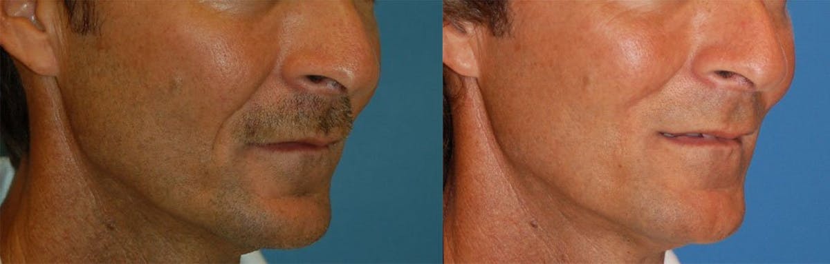 Nasolabial Folds Before & After Gallery - Patient 122406418 - Image 2