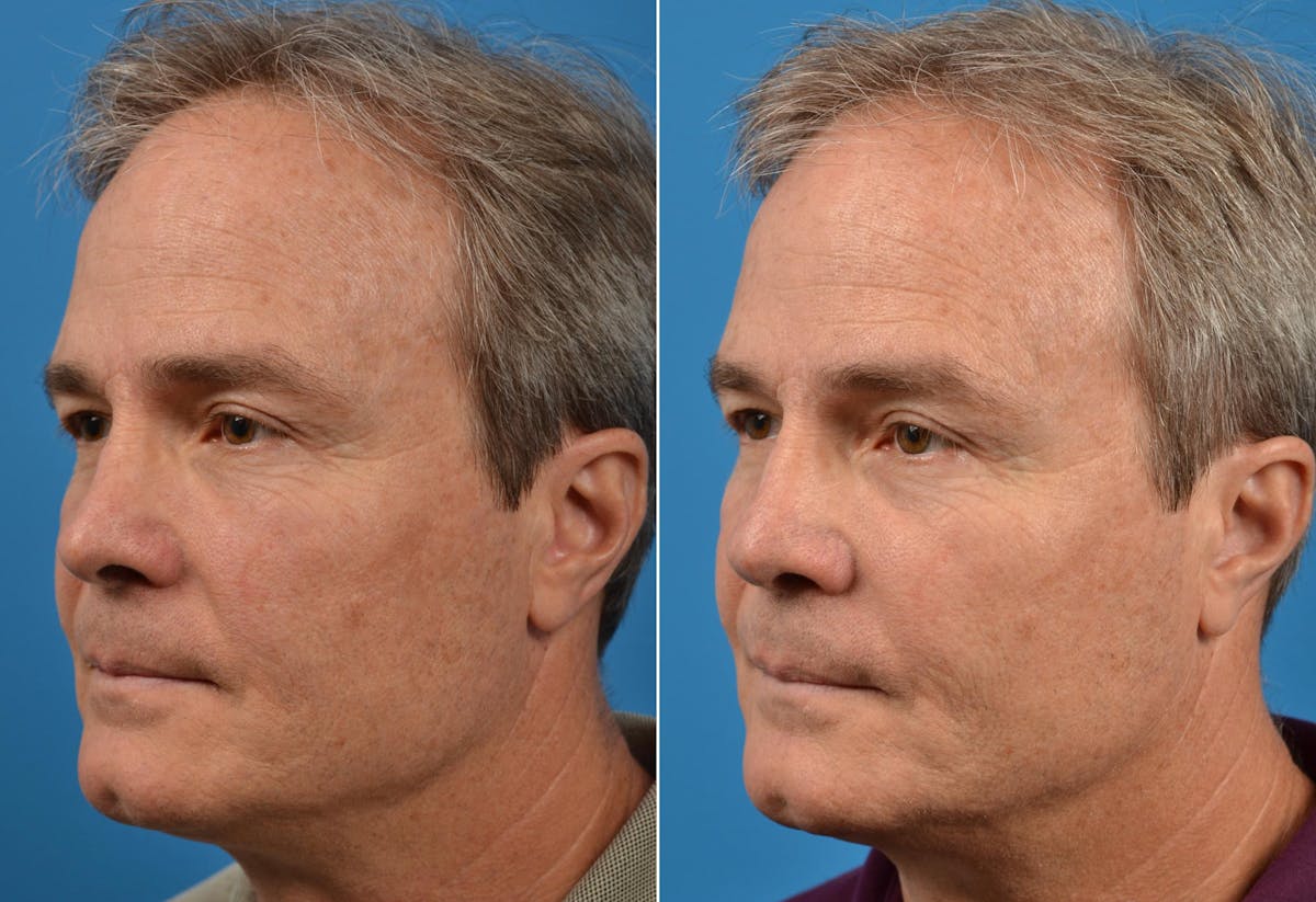 Male Rhinoplasty Before & After Gallery - Patient 122406419 - Image 5