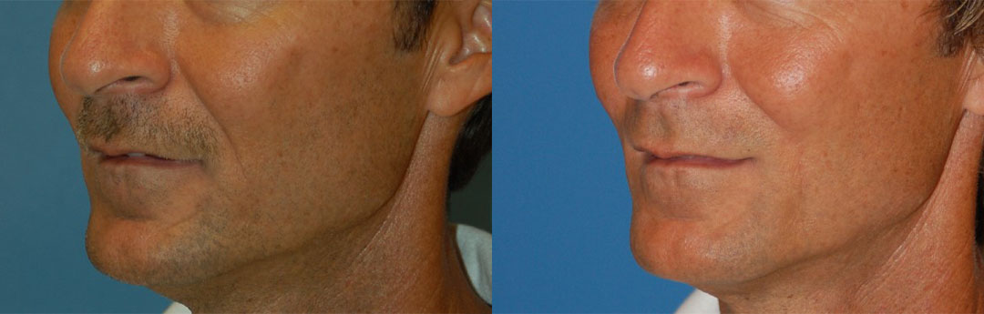 Nasolabial Folds Before & After Gallery - Patient 122406418 - Image 3