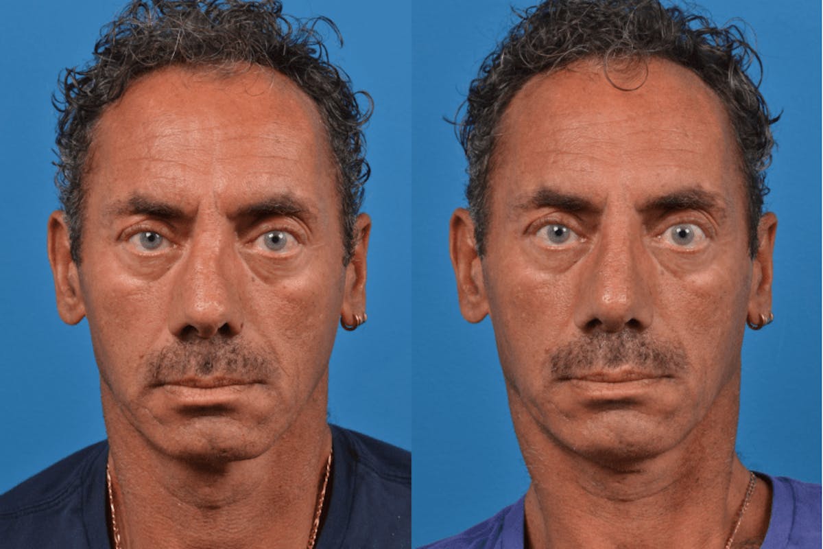 Male Rhinoplasty Before & After Gallery - Patient 122406425 - Image 1