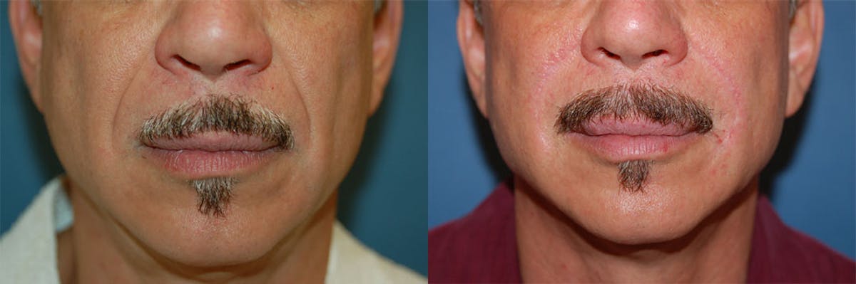 Nasolabial Folds Before & After Gallery - Patient 122406422 - Image 1
