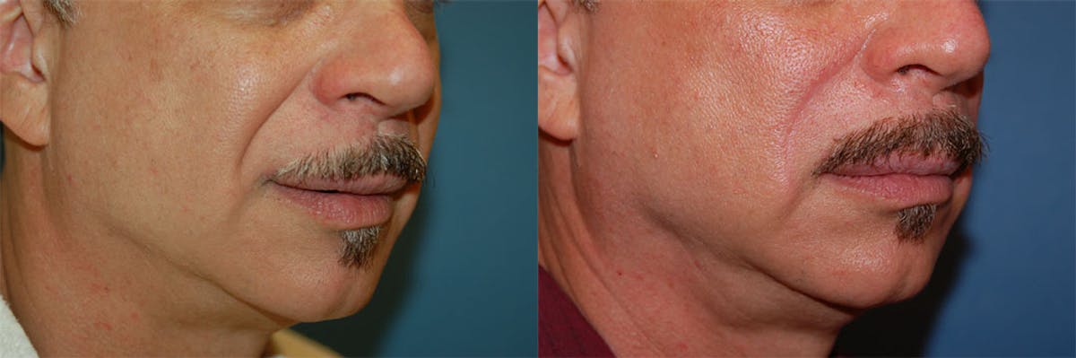 Nasolabial Folds Before & After Gallery - Patient 122406422 - Image 2