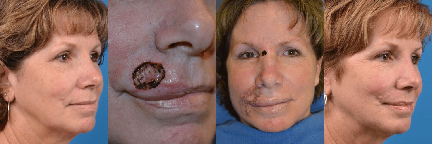 Mohs Surgery and Skin Cancer Before & After Gallery - Patient 122406421 - Image 1