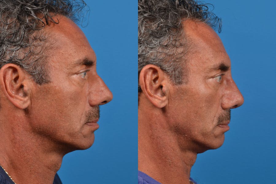 Male Rhinoplasty Before & After Gallery - Patient 122406425 - Image 2