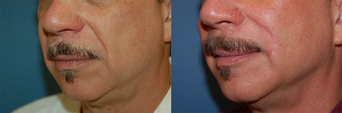 Nasolabial Folds Before & After Gallery - Patient 122406422 - Image 3