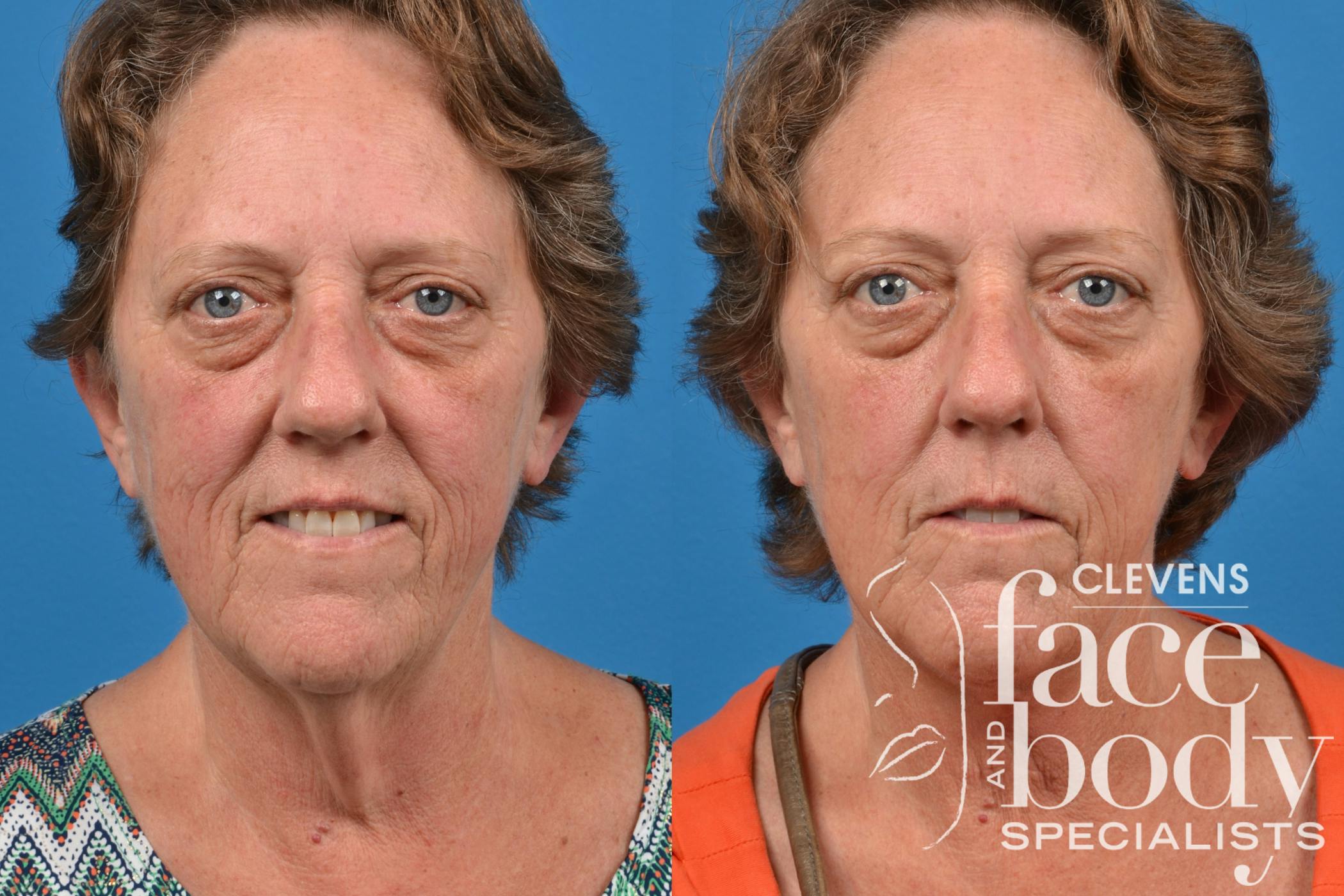 Neck Lift
