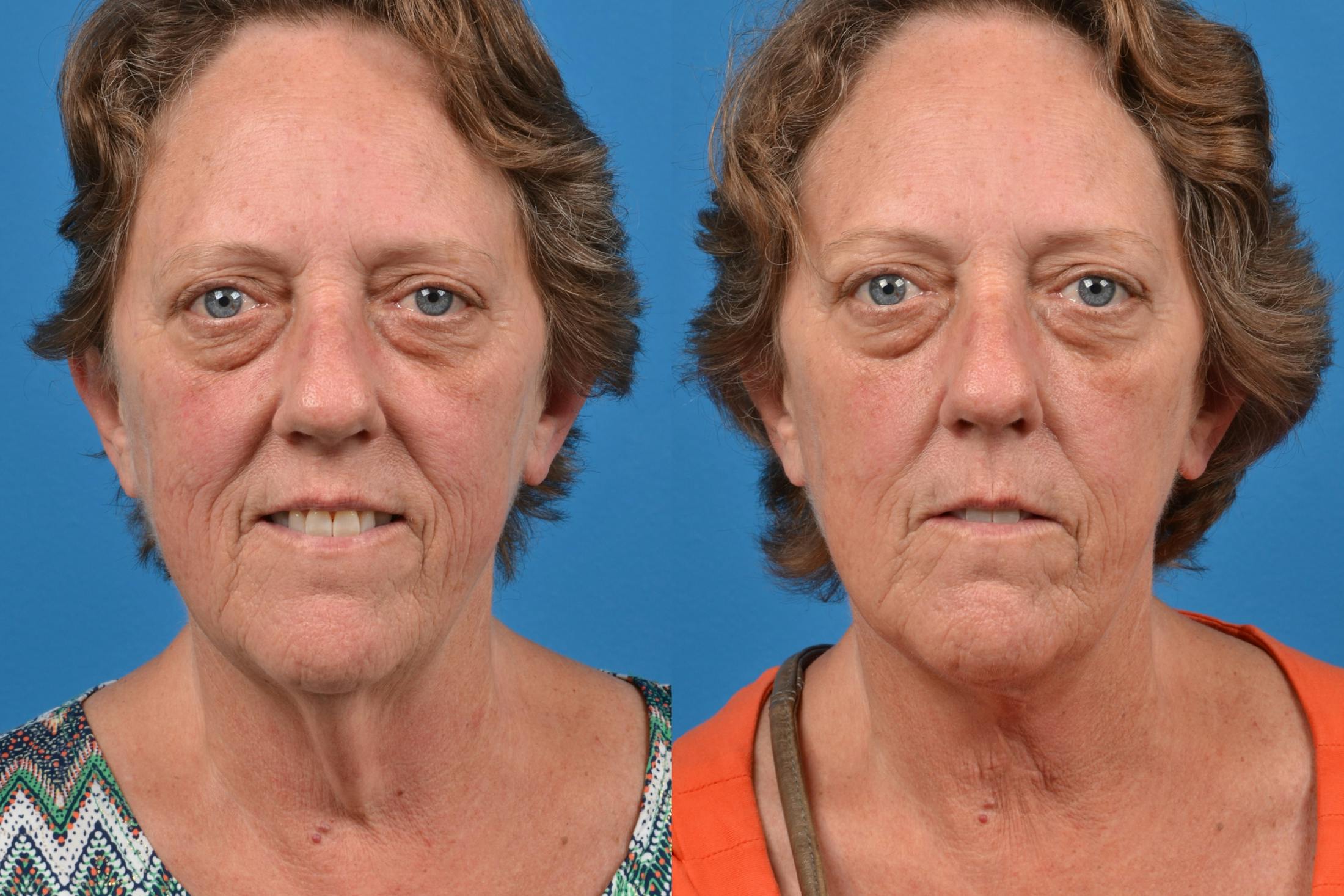 Profile Neck Lift Before & After Gallery - Patient 122406433 - Image 1