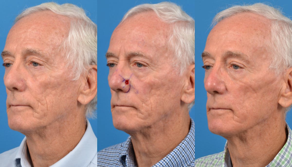 Mohs Surgery and Skin Cancer Before & After Gallery - Patient 122406424 - Image 1