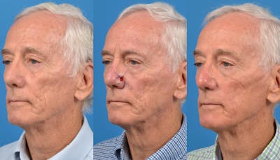 Mohs Surgery and Skin Cancer Before & After Gallery - Patient 122406424 - Image 1