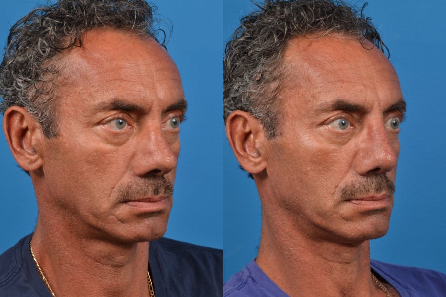 Male Rhinoplasty Before & After Gallery - Patient 122406425 - Image 3