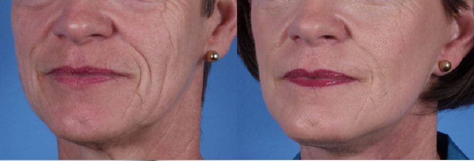 Nasolabial Folds Before & After Gallery - Patient 122406423 - Image 1