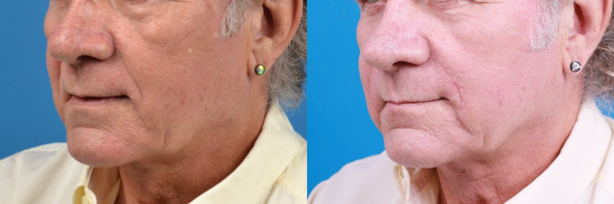 Nasolabial Folds Before & After Gallery - Patient 122406428 - Image 1