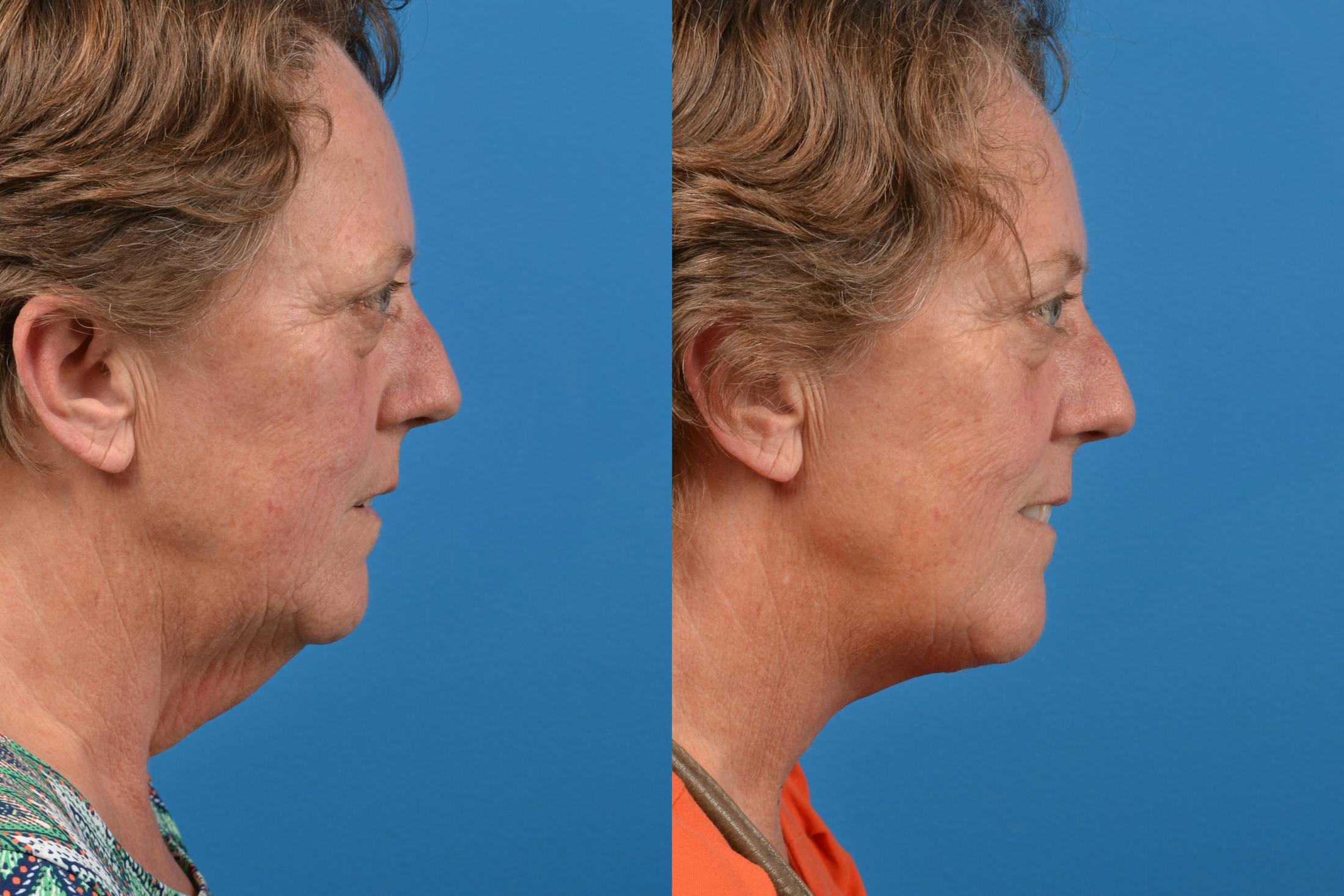 Profile Neck Lift Before & After Gallery - Patient 122406433 - Image 2