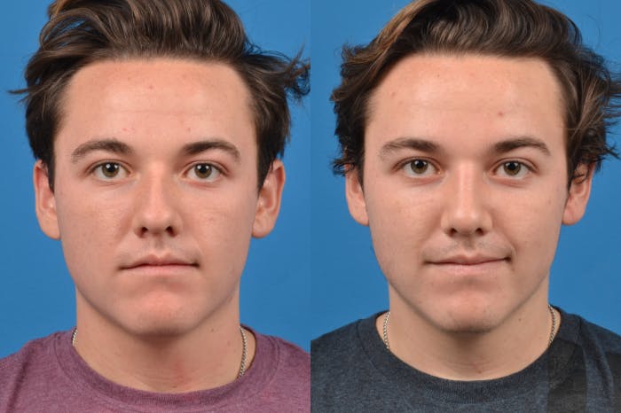 Male Rhinoplasty Before & After Gallery - Patient 122406430 - Image 1